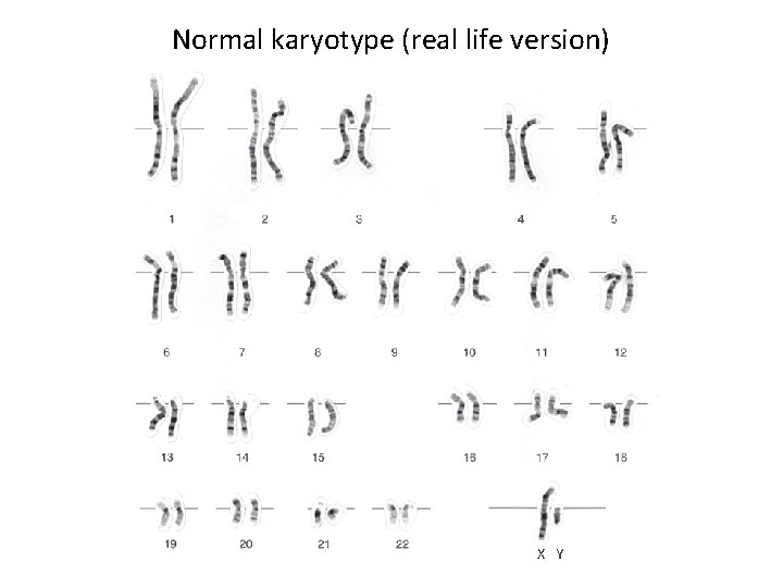 Normal karyotype (real life version) X Y 