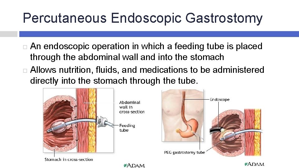 Percutaneous Endoscopic Gastrostomy An endoscopic operation in which a feeding tube is placed through