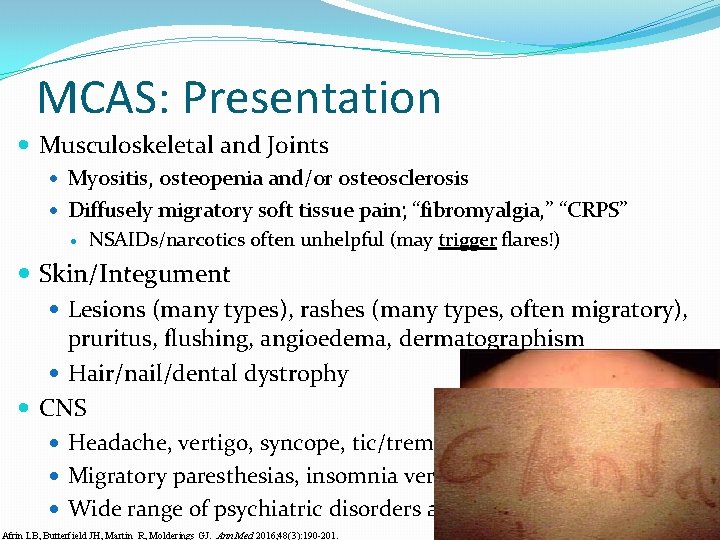 MCAS: Presentation Musculoskeletal and Joints Myositis, osteopenia and/or osteosclerosis Diffusely migratory soft tissue pain;
