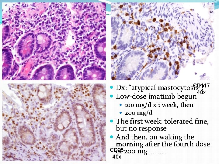 H&E CD 117 Dx: “atypical mastocytosis”? 40 x Low-dose imatinib begun 100 mg/d x