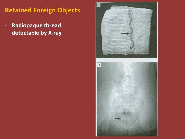 Retained Foreign Objects - Radiopaque thread detectable by X-ray 