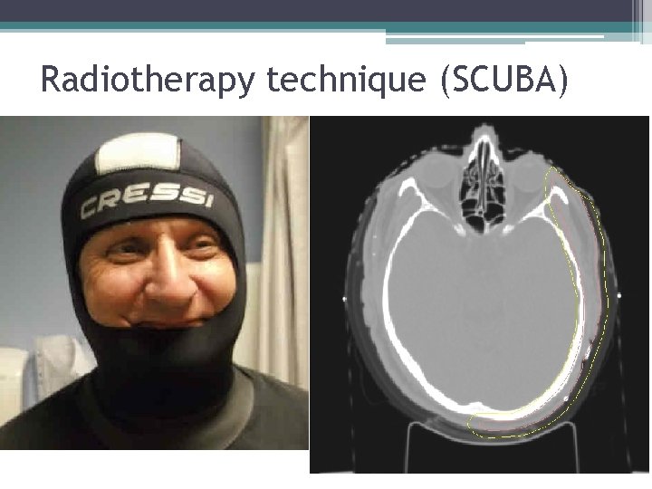 Radiotherapy technique (SCUBA) 