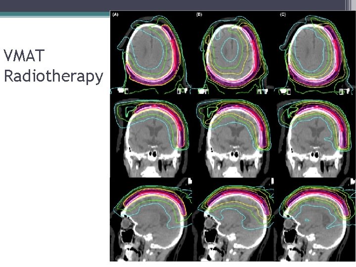 VMAT Radiotherapy 