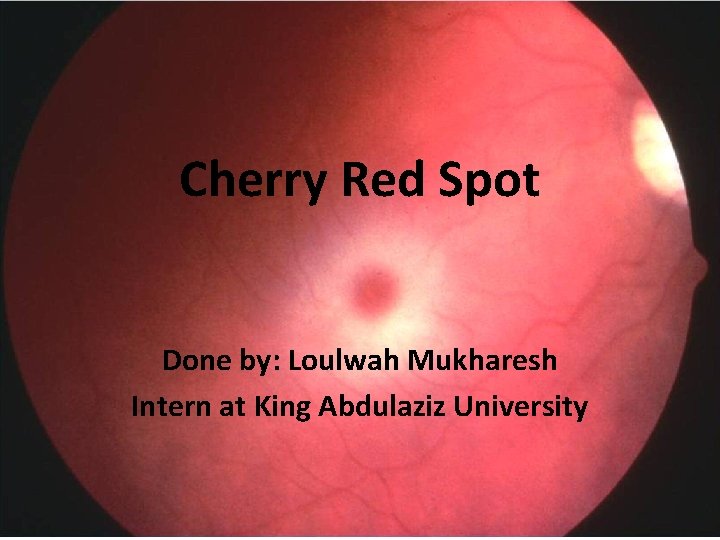 Cherry Red Spot Done by: Loulwah Mukharesh Intern at King Abdulaziz University 