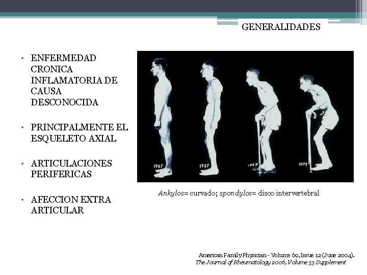 GENERALIDADES • ENFERMEDAD CRONICA INFLAMATORIA DE CAUSA DESCONOCIDA • PRINCIPALMENTE EL ESQUELETO AXIAL •