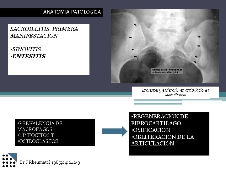 ANATOMIA PATOLOGICA SACROILEITIS PRIMERA MANIFESTACION • SINOVITIS • ENTESITIS Erosiones y esclerosis en articulaciones