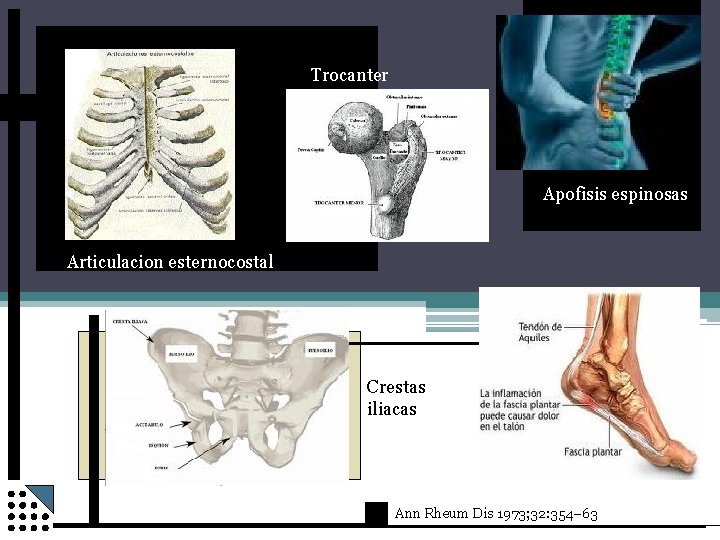 Trocanter Apofisis espinosas Articulacion esternocostal Crestas iliacas Ann Rheum Dis 1973; 32: 354– 63