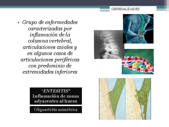 GENERALIDADES • Grupo de enfermedades caracterizadas por inflamación de la columna vertebral, articulaciones axiales