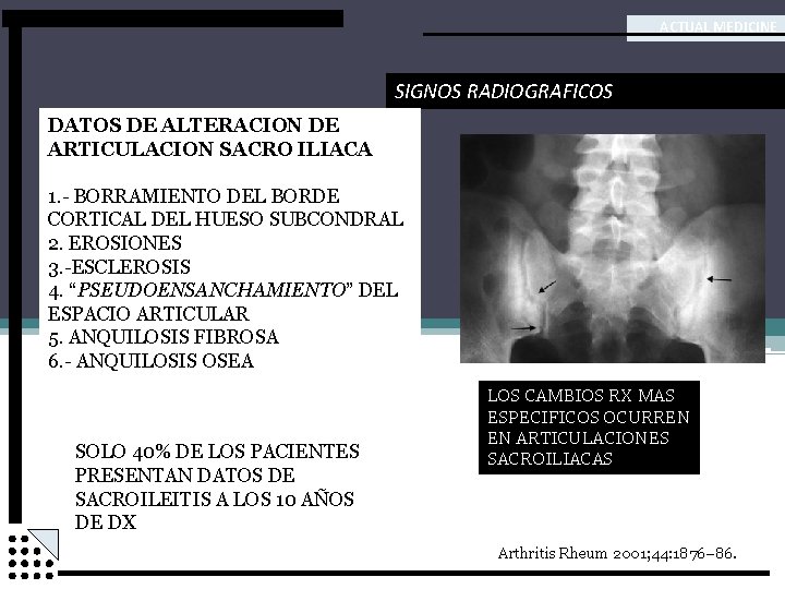 ACTUAL MEDICINE SIGNOS RADIOGRAFICOS DATOS DE ALTERACION DE ARTICULACION SACRO ILIACA 1. - BORRAMIENTO
