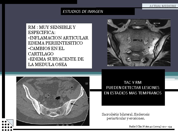 ACTUAL MEDICINE ESTUDIOS DE IMAGEN RM : MUY SENSIBLE Y ESPECIFICA: • INFLAMACION ARTICULAR