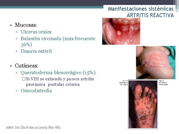 Manifestaciones sistémicas ARTRITIS REACTIVA • Mucosas: ▫ Ulceras orales ▫ Balanitis circinada (más frecuente
