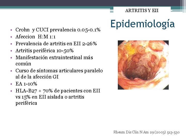 ARTRITIS Y EII • • • Crohn y CUCI prevalencia 0. 05 -0. 1%