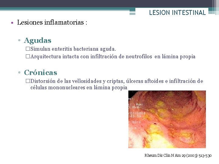 LESION INTESTINAL • Lesiones inflamatorias : ▫ Agudas �Simulan enteritis bacteriana aguda. �Arquitectura intacta