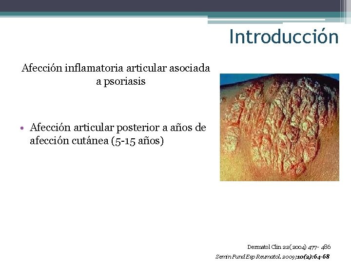 Introducción Afección inflamatoria articular asociada a psoriasis • Afección articular posterior a años de