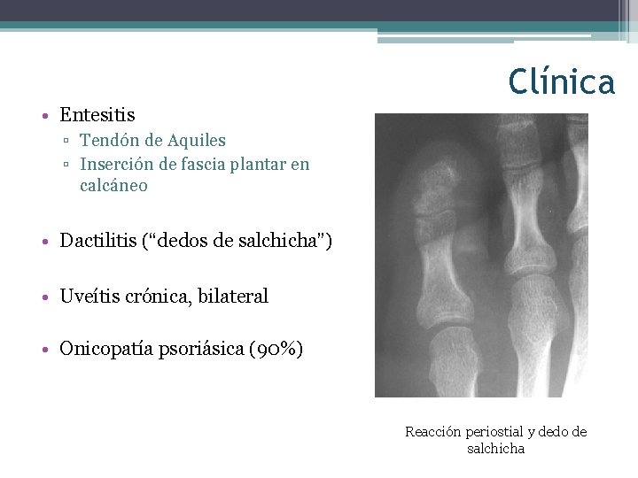 Clínica • Entesitis ▫ Tendón de Aquiles ▫ Inserción de fascia plantar en calcáneo