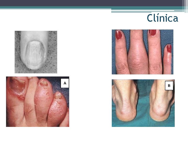 Clínica Dermatol Clin 22 (2004) 477 - 486 