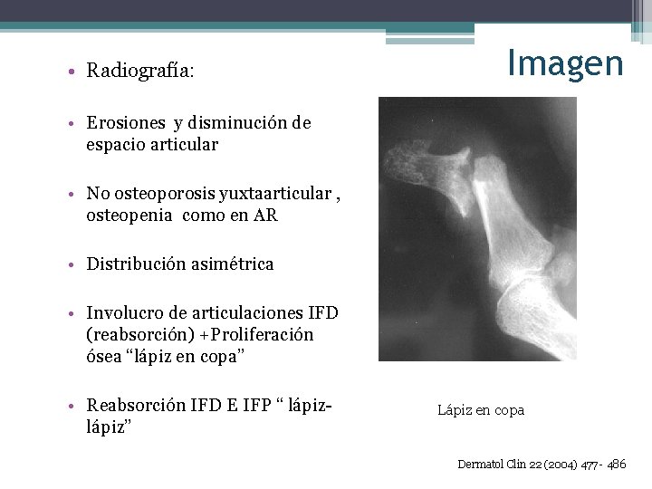  • Radiografía: Imagen • Erosiones y disminución de espacio articular • No osteoporosis