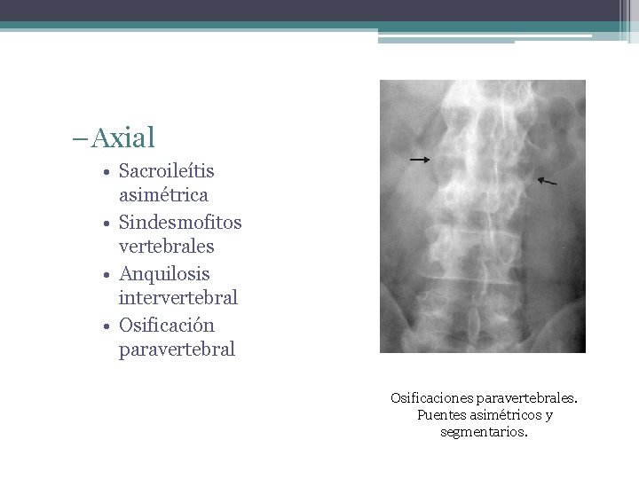 – Axial • Sacroileítis asimétrica • Sindesmofitos vertebrales • Anquilosis intervertebral • Osificación paravertebral