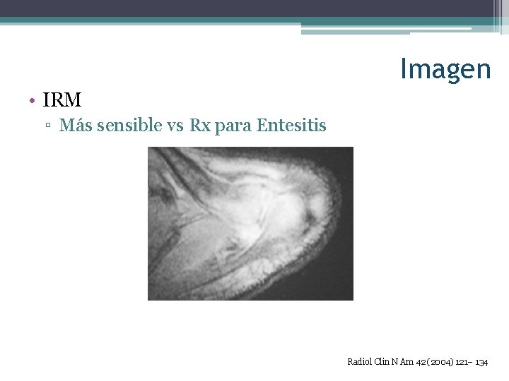 Imagen • IRM ▫ Más sensible vs Rx para Entesitis Radiol Clin N Am