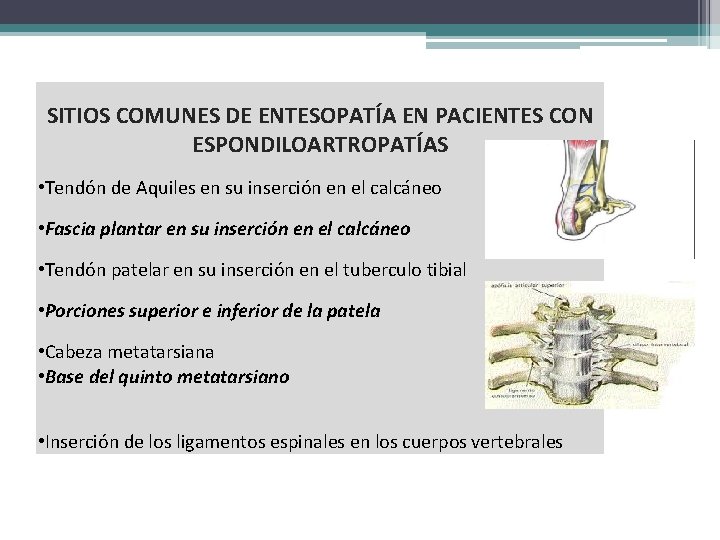 SITIOS COMUNES DE ENTESOPATÍA EN PACIENTES CON ESPONDILOARTROPATÍAS • Tendón de Aquiles en su