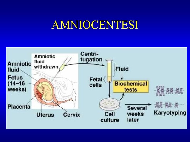 AMNIOCENTESI 