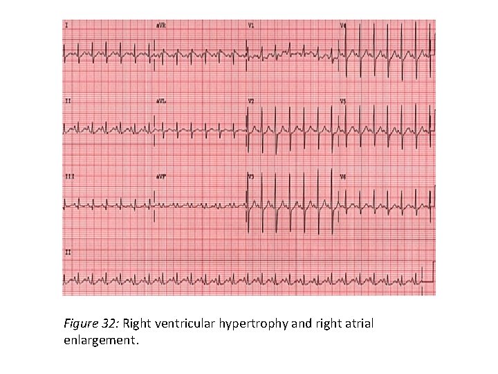 Figure 32: Right ventricular hypertrophy and right atrial enlargement. 