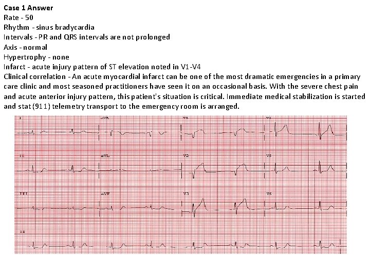 Case 1 Answer Rate - 50 Rhythm - sinus bradycardia Intervals - PR and