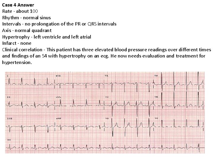 Case 4 Answer Rate - about 100 Rhythm - normal sinus Intervals - no