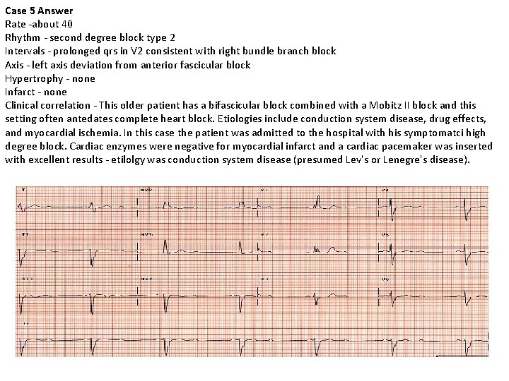 Case 5 Answer Rate -about 40 Rhythm - second degree block type 2 Intervals