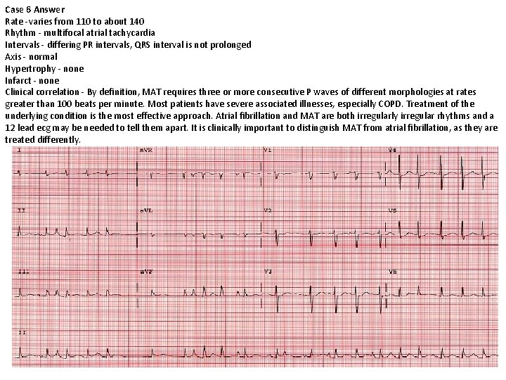 Case 6 Answer Rate -varies from 110 to about 140 Rhythm - multifocal atrial