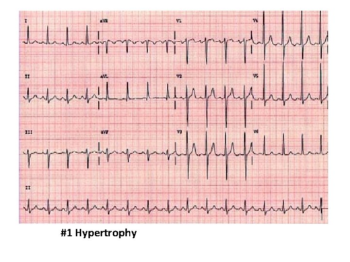 #1 Hypertrophy 