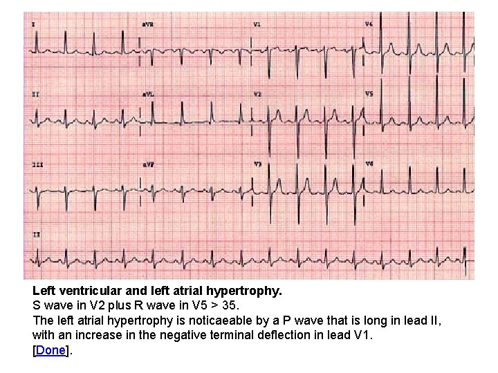 Left ventricular and left atrial hypertrophy. S wave in V 2 plus R wave