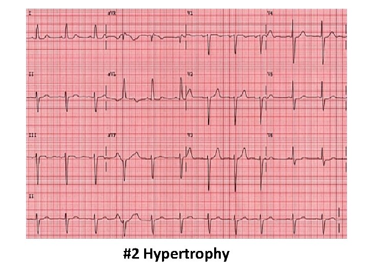 #2 Hypertrophy 