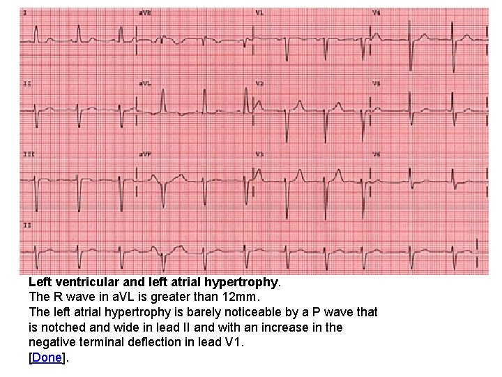 Left ventricular and left atrial hypertrophy. The R wave in a. VL is greater