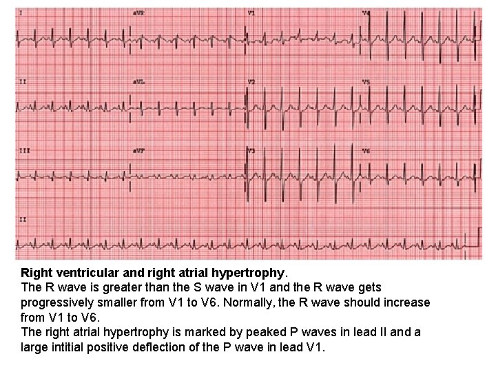 Right ventricular and right atrial hypertrophy. The R wave is greater than the S