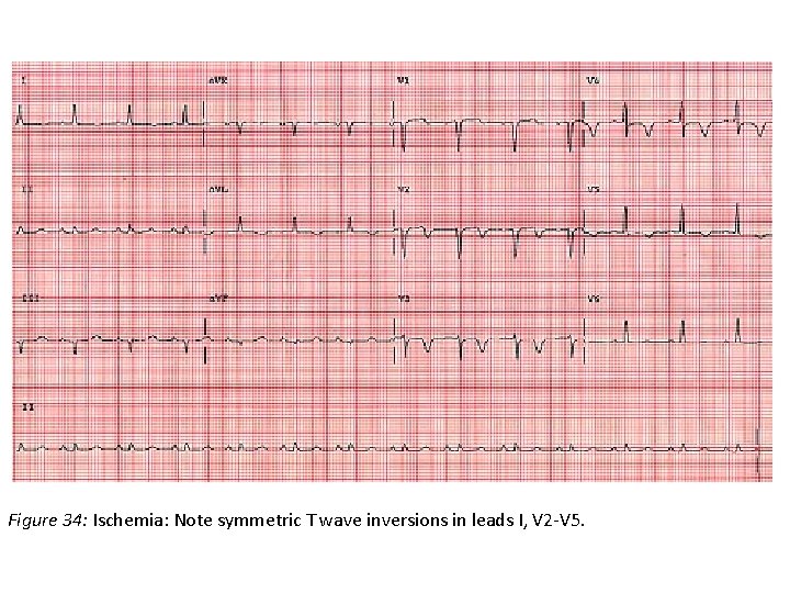 Figure 34: Ischemia: Note symmetric T wave inversions in leads I, V 2 -V