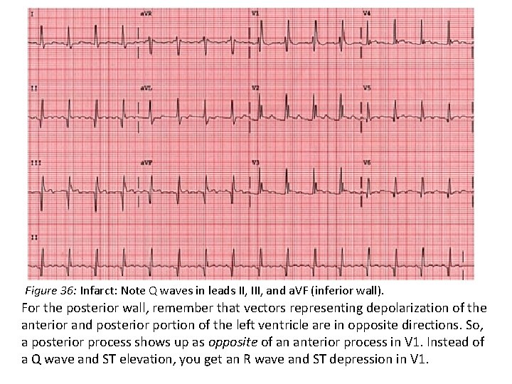 Figure 36: Infarct: Note Q waves in leads II, III, and a. VF (inferior