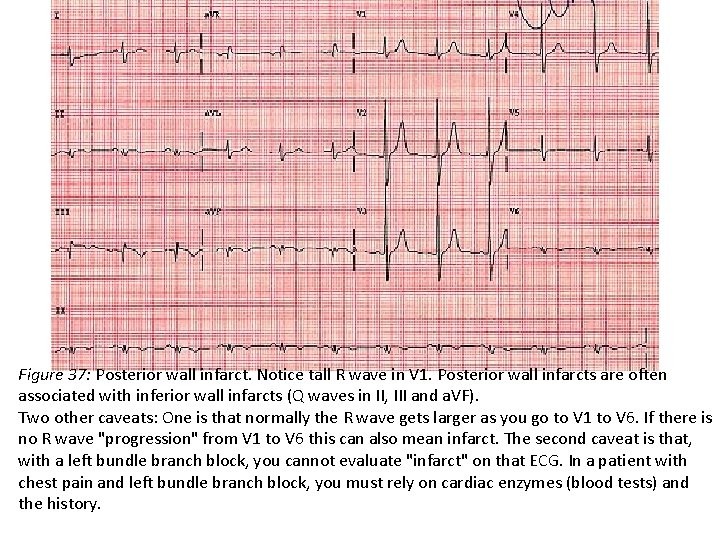 Figure 37: Posterior wall infarct. Notice tall R wave in V 1. Posterior wall