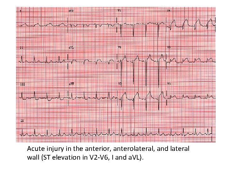 Acute injury in the anterior, anterolateral, and lateral wall (ST elevation in V 2