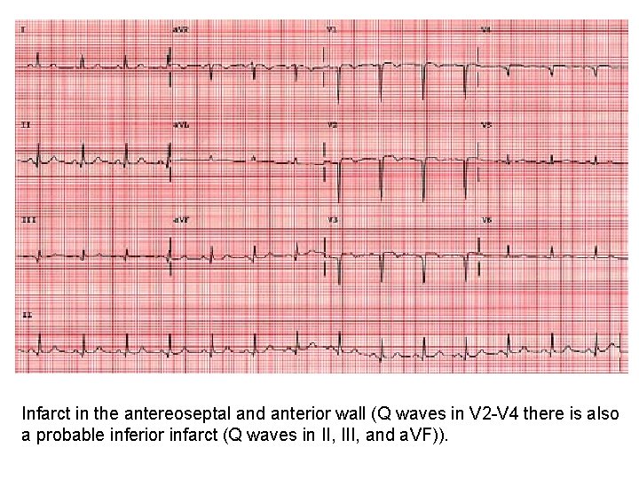 Infarct in the antereoseptal and anterior wall (Q waves in V 2 -V 4