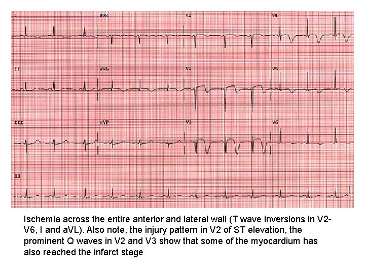 Ischemia across the entire anterior and lateral wall (T wave inversions in V 2