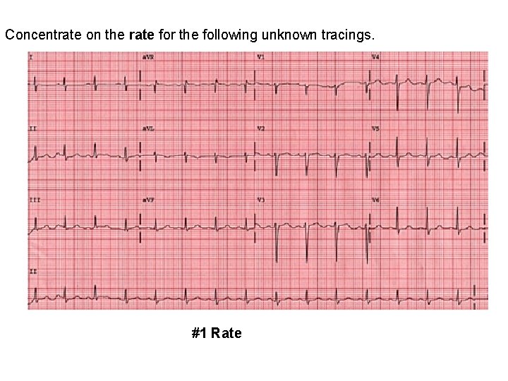 Concentrate on the rate for the following unknown tracings. #1 Rate 