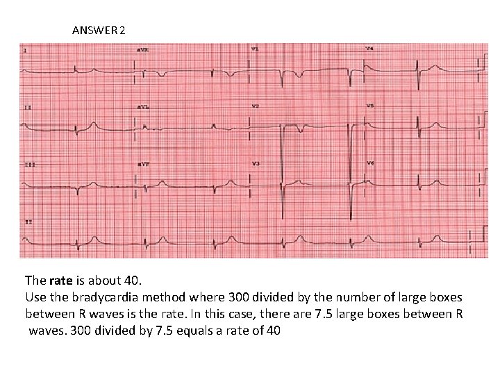 ANSWER 2 The rate is about 40. Use the bradycardia method where 300 divided