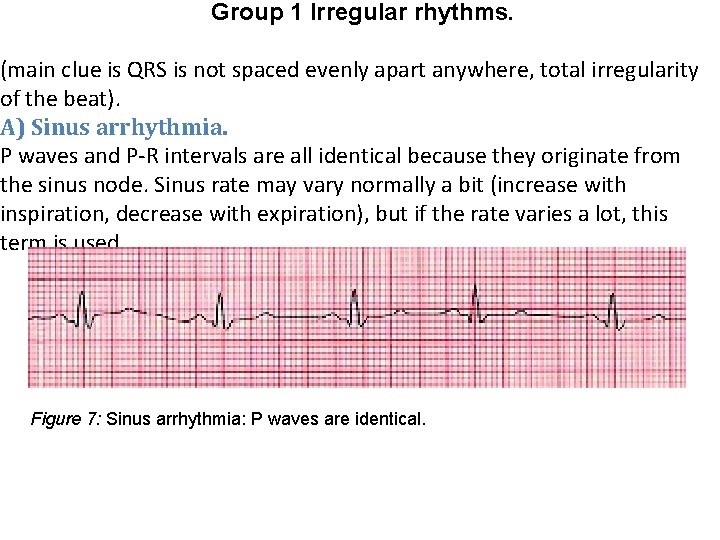 Group 1 Irregular rhythms. (main clue is QRS is not spaced evenly apart anywhere,