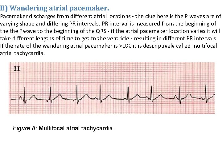 B) Wandering atrial pacemaker. Pacemaker discharges from different atrial locations - the clue here