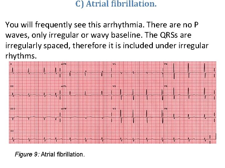 C) Atrial fibrillation. You will frequently see this arrhythmia. There are no P waves,