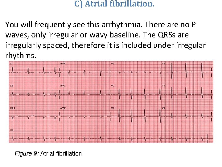 C) Atrial fibrillation. You will frequently see this arrhythmia. There are no P waves,