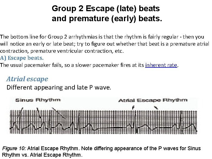 Group 2 Escape (late) beats and premature (early) beats. The bottom line for Group