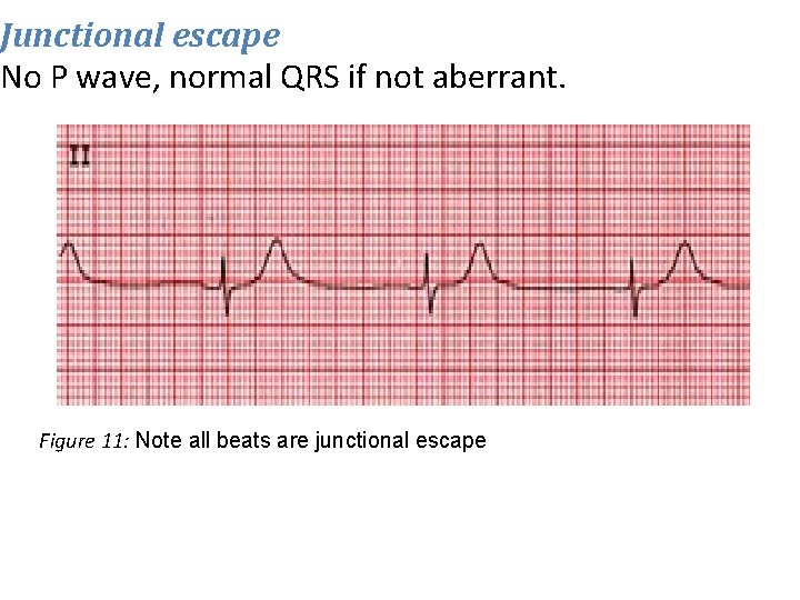 Junctional escape No P wave, normal QRS if not aberrant. Figure 11: Note all