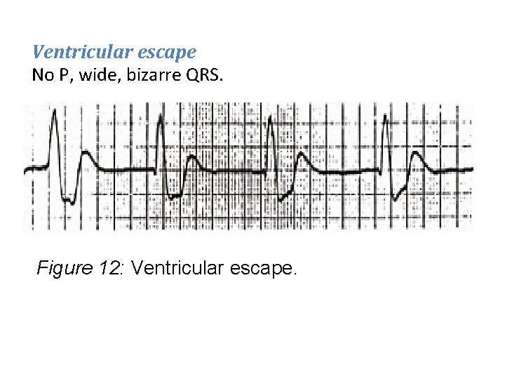 Ventricular escape No P, wide, bizarre QRS. Figure 12: Ventricular escape. 